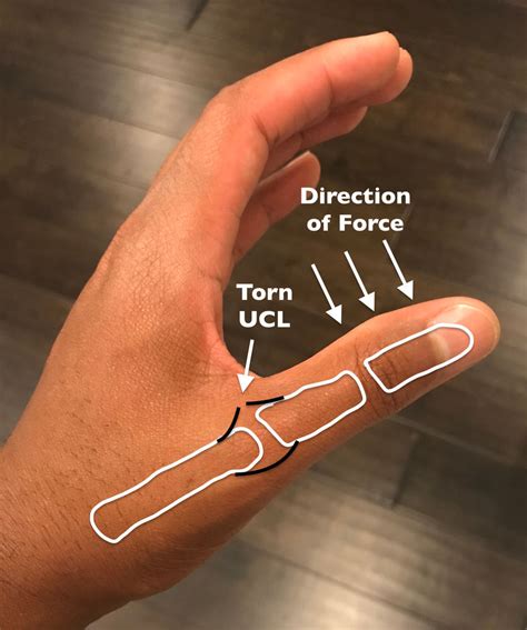 ucl thumb tear recovery time